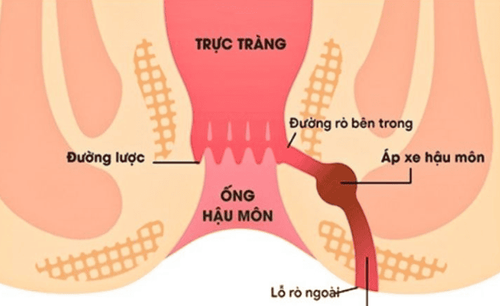 Điều trị can thiệp bệnh viêm ruột có rò hậu môn 