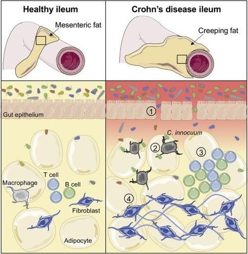 Mối liên quan giữa mô mỡ mạc treo ruột (MAT) và bệnh Crohn