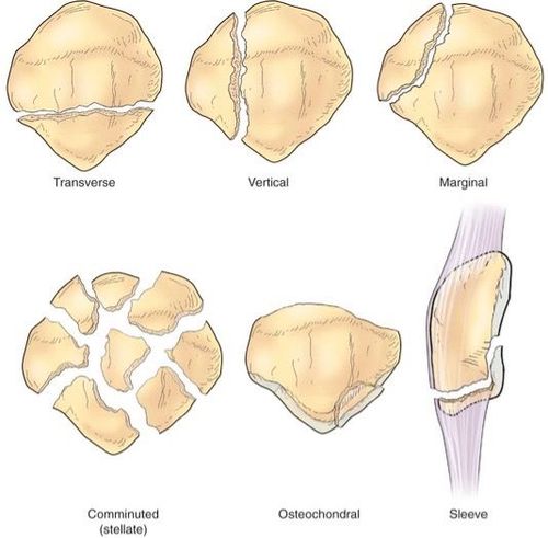 Gãy xương bánh chè có nguy hiểm không còn tùy thuộc vào vị trí và mức độ tổn thương. 