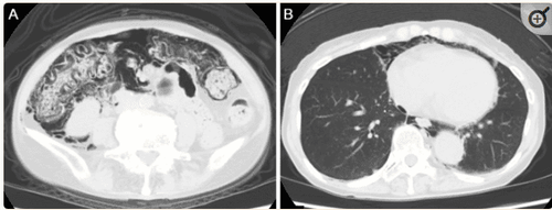 Hình ảnh CT Scan: CT được thực hiện một tháng sau khi nội soi đại tràng cho thấy có khí trong thành ruột già và khí ổ bụng (A). Khí phế thũng trung thất cũng được ghi nhận (B).