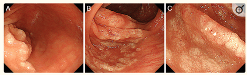 Hình ảnh nội soi đại tràng. Quan sát thấy các tổn thương màu trắng hơi nhô lên ở manh tràng (A) và đại tràng lên (B, C).
