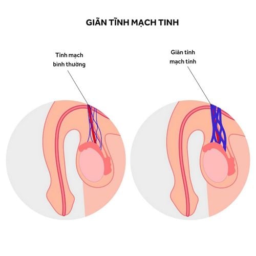 Giãn tĩnh mạch tinh - căn bệnh gây hiếm muộn phổ biến ở nam giới