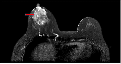 Bằng phương pháp chụp MRI, hình ảnh tổn thương sẽ phản ánh chính xác hơn cấu trúc và đặc điểm, giảm thiểu tối đa các yếu tố gây nhiễu từ phù nề hay chảy máu sau sinh thiết. Ngoài ra, việc chụp MRI sau sinh thiết ít nhất 7–10 ngày cũng giúp hình ảnh hiển thị rõ ràng và hỗ trợ rất nhiều trong lập kế hoạch điều trị hiệu quả.

Trung tâm Vú Vinmec Times City là một trong những đơn vị y tế được trang bị đầy đủ các phương tiện để chẩn đoán và sàng lọc ung thư, đặc biệt là ung thư vú như: máy siêu âm 2D, 3D, nhũ ảnh 2D, 3D, máy chụp cộng hưởng từ (MRI) tuyến vú…cũng như quy tụ các chuyên gia ung bướu đầu ngành có khả năng tối ưu hóa kết quả chẩn đoán và điều trị cho người bệnh.