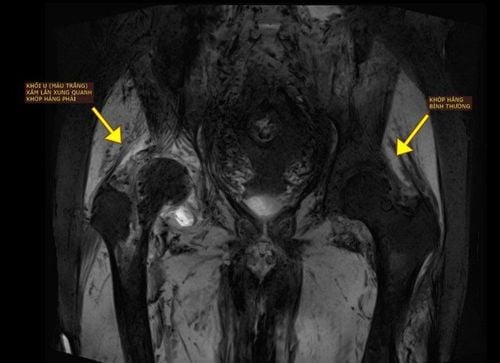 The metastatic bone cancer had invaded the entire structure around the hip joint, including the pelvis, joint capsule, and upper femur.