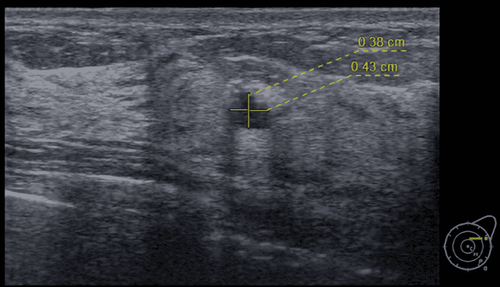 Ultrasound image after intervention, the tumor has been completely removed, only a small amount of fluid accumulation