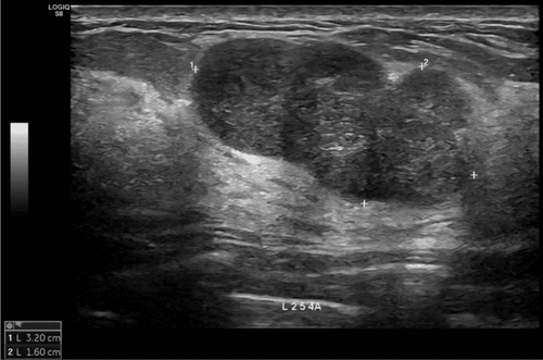 Actual ultrasound image of the left breast tumor before intervention