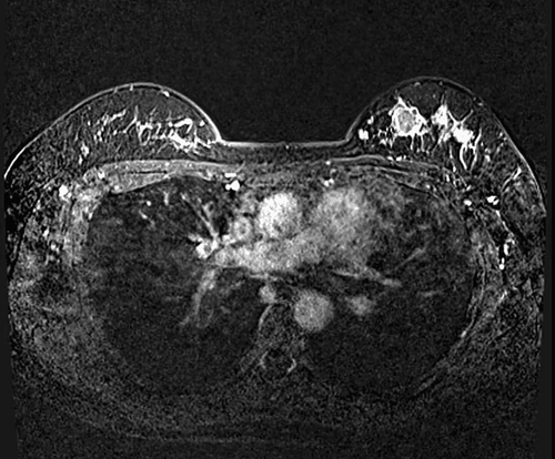 Image of left breast enhancement on MRI