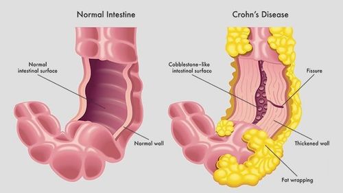 Liệu mỡ tích tụ có làm triệu chứng bệnh Crohn của bạn trở nên trầm trọng hơn không?