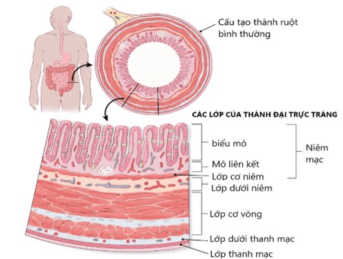 Những điều cần biết về ung thư đại trực tràng, triệu chứng và điều trị