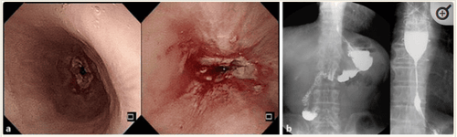 a Nội soi thực quản tá tràng cho thấy hẹp thực quản nghiêm trọng và ăn mòn niêm mạc có dịch tiết. Ống soi có đường kính 5 mm thậm chí không thể đi qua vị trí hẹp. b  Chụp thực quản cản quang cho thấy hẹp dài khoảng 4 cm ở đoạn thực quản giữa đến thực quản xa và thuốc cản quang di chuyển qua vị trí hẹp khó khăn