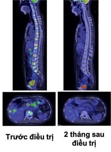 Hiệu quả của OPDIVO (NIVOLUMAB) và cập nhật một số chỉ định mới được phê duyệt