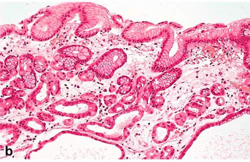 Polyp tuyến đáy vị với các tuyến giãn dạng nang và các tế bào thành tăng sản lan rộng đến các hố. Nhuộm hematoxylin và eosin. ( a ) ×40, ( b ) ×200