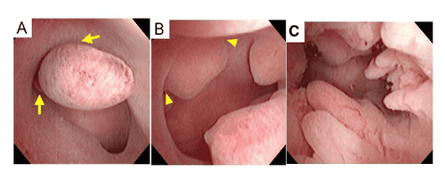 Hình minh họa. (A): Polyp có cuống (góc giữa polyp và NMTC < 90 độ) (B): Polyp không có cuống (góc giữa polyp và NMTC là 90 độ) (C): Trường hợp đa polyp 