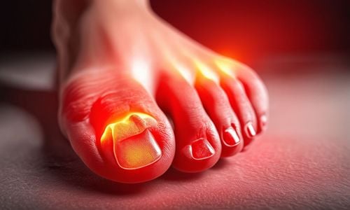 Triệu chứng bệnh Gout sớm mà người bệnh cần biết