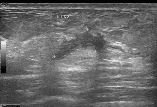 Spectacular journey: Resection of a 5cm giant breast tumor through a 3mm incision