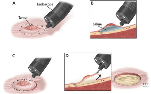 Phân loại mới về polyp dạ dày: Polyp dạ dày nguy cơ ác tính cao