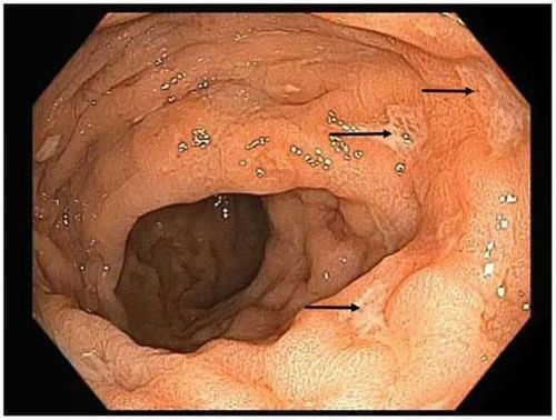 Chẩn đoán viêm trực tràng do Mycobacterium avium-intracellulare ở bệnh nhân nhiễm HIV