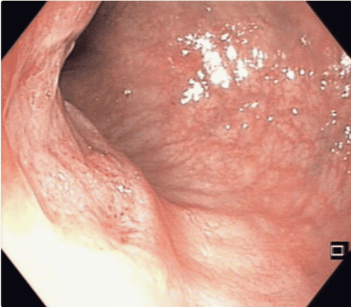 Viêm trực tràng do Chlamydia trachomatis : Bệnh lây lan qua đường tình dục trong trực tràng