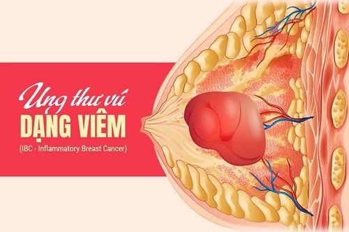 Ung thư vú di căn xương sống được bao lâu: Giải đáp thắc mắc