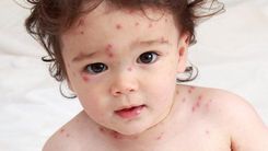 Care for children with chickenpox properly to avoid dangerous complications