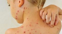 Chickenpox can be dangerous complications, parents cannot be subjective