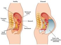 Treatment of peritoneal effusion