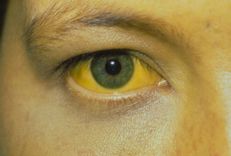 Diagnosis and treatment of obstructive jaundice