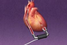 Đặc điểm của thiết bị hỗ trợ thất trái (LVAD)