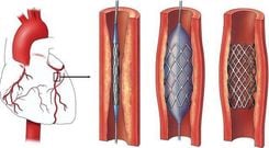 Lifespan of Coronary Stents