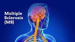 What is multiple sclerosis?