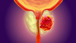 Prostate Calcification and Its Treatment