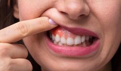 How should gingivitis at the root of the tooth be treated?