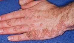 Mycosis fungoides: What you need to know