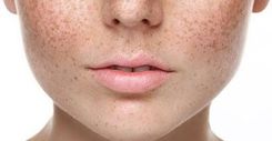 Distinguish melasma and freckles