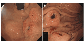 Hình ảnh nội soi của di căn dạ dày từ ung thư phổi tế bào nhỏ