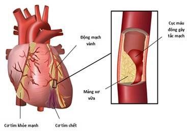 Bệnh tim mạch sàng lọc sớm tránh nguy cơ đột quỵ