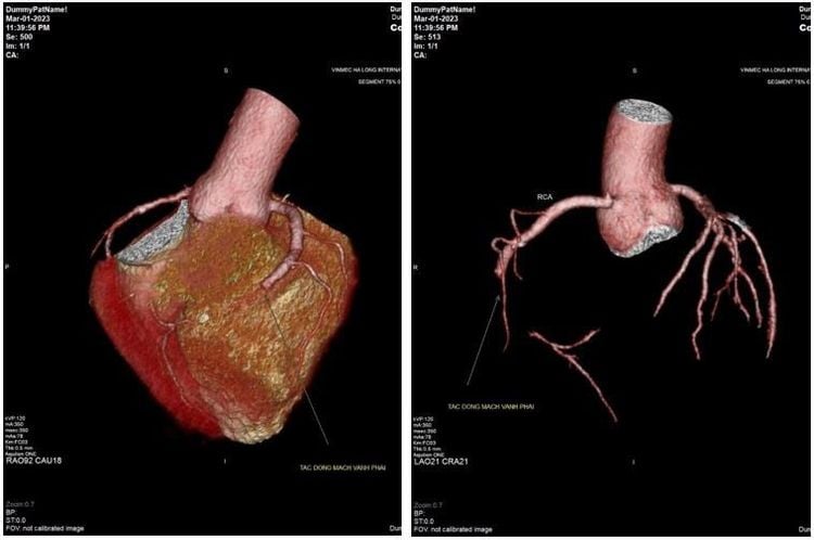 Hình ảnh tắc động mạch trên MSCT (Nguồn ảnh: Vinmec)