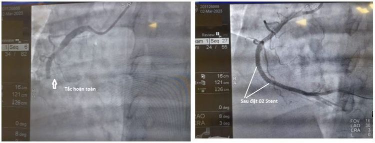Hình ảnh trước vào sau đặt 2 stent (Nguồn ảnh: Vinmec)