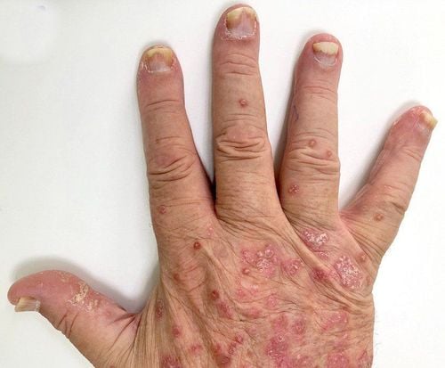 15 cách để hạn chế cơn bùng phát bệnh viêm khớp vảy nến
